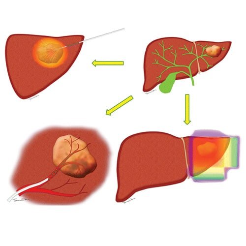 hepatobiliary