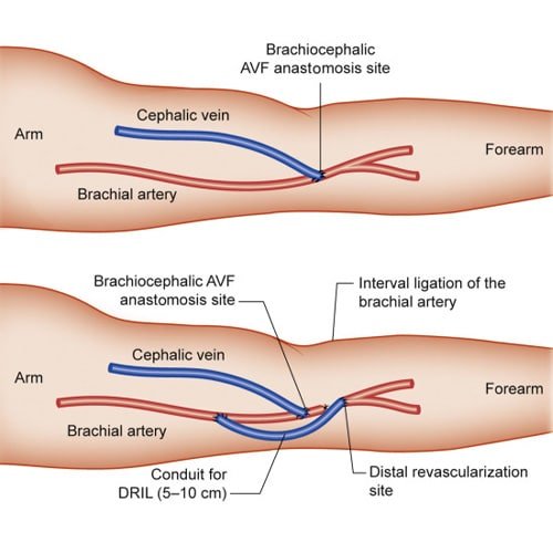 revascularization of dialysis