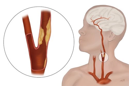 carotid artery