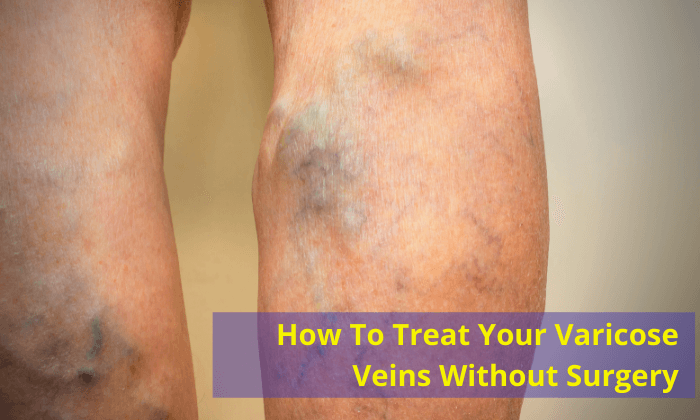 How-To-Treat-Your-Varicose-Veins-Without-Surgery-dr. jathin