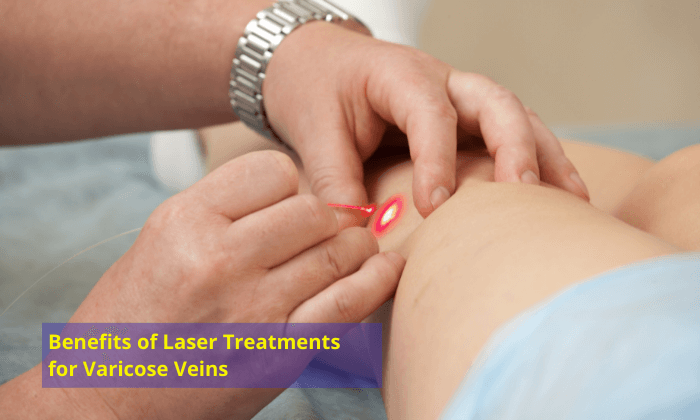 The Benefits of Laser Treatments for Varicose Veins com 1