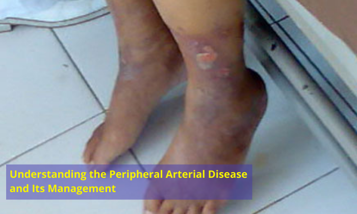 Understanding-the-Peripheral-Arterial-Disease-and-Its-Management