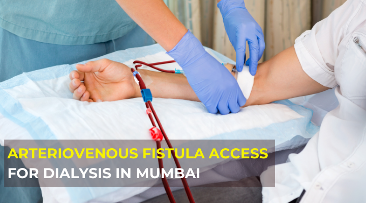 arteriovenous fistula access for dialysis