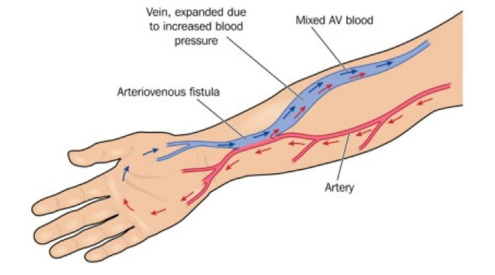 Arteriovenous Fistula access for Dialysis