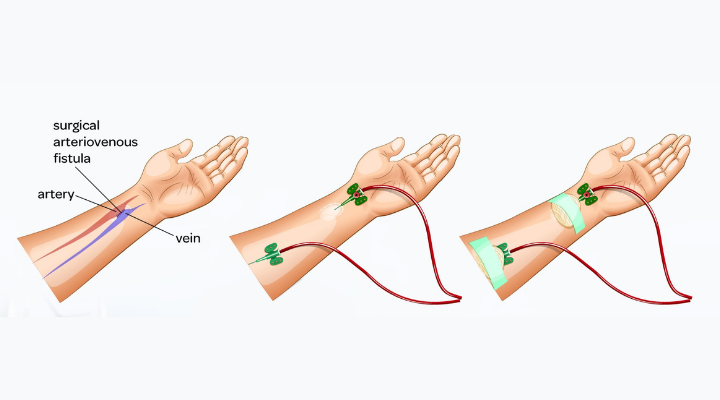 Arteriovenous Fistula access for Dialysis