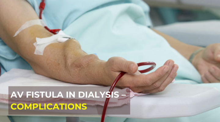 Arteriovenous Fistula access for Dialysis