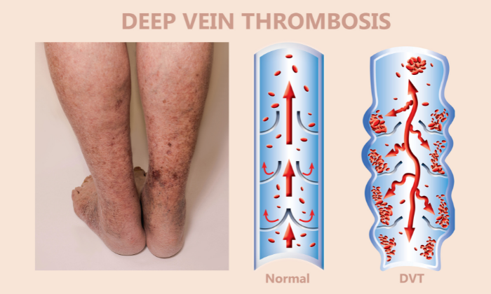 deep vein thrombosis