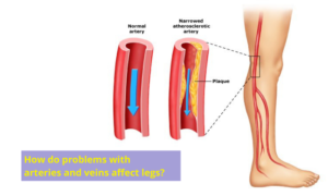 How problems with Arteries and Veins affect Legs, Brain, and Kidney ...