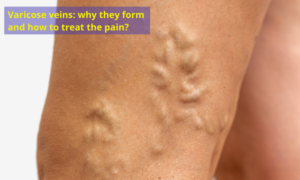 Varicose veins: why they form and how to treat the pain - Dr. Jathin's ...