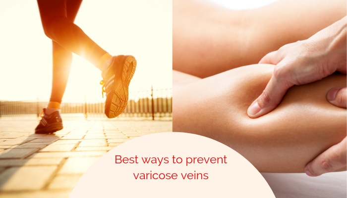 The Complete Guide to Varicose Veins and the Best Time to Treat Them1