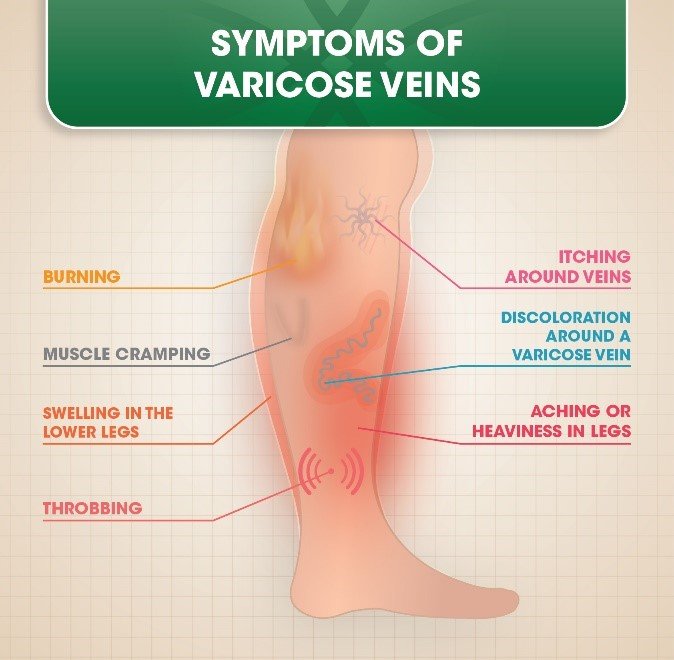 The Impact of Varicose Veins on Your Sleep Patterns1