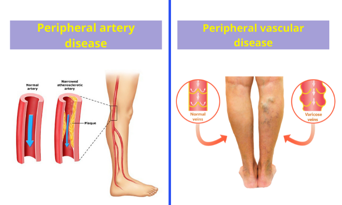 How to Sleep With Varicose Veins