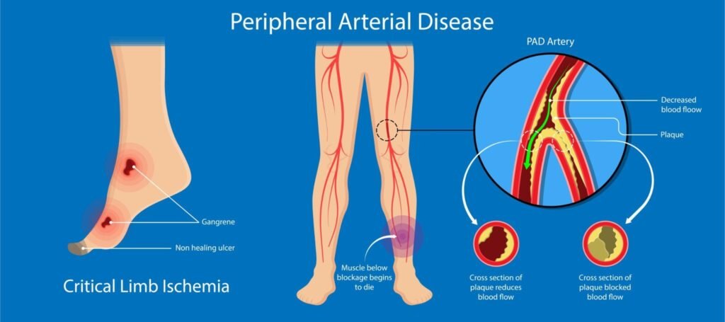 A-Comprehensive-Guide-to-Assessing-Peripheral-Artery-Disease