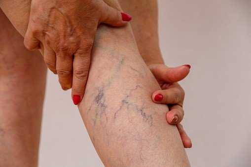 Does Your High Sugar Intake Really Lead To Vein Disease-1