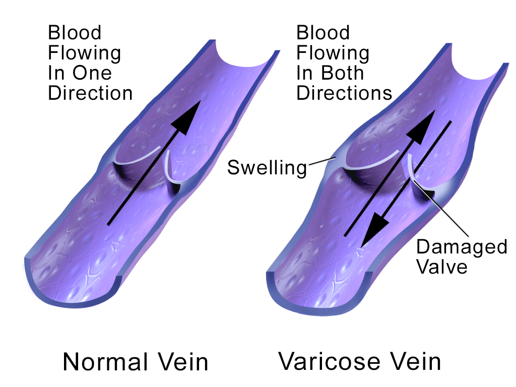 Does Your High Sugar Intake Really Lead To Vein Disease-2