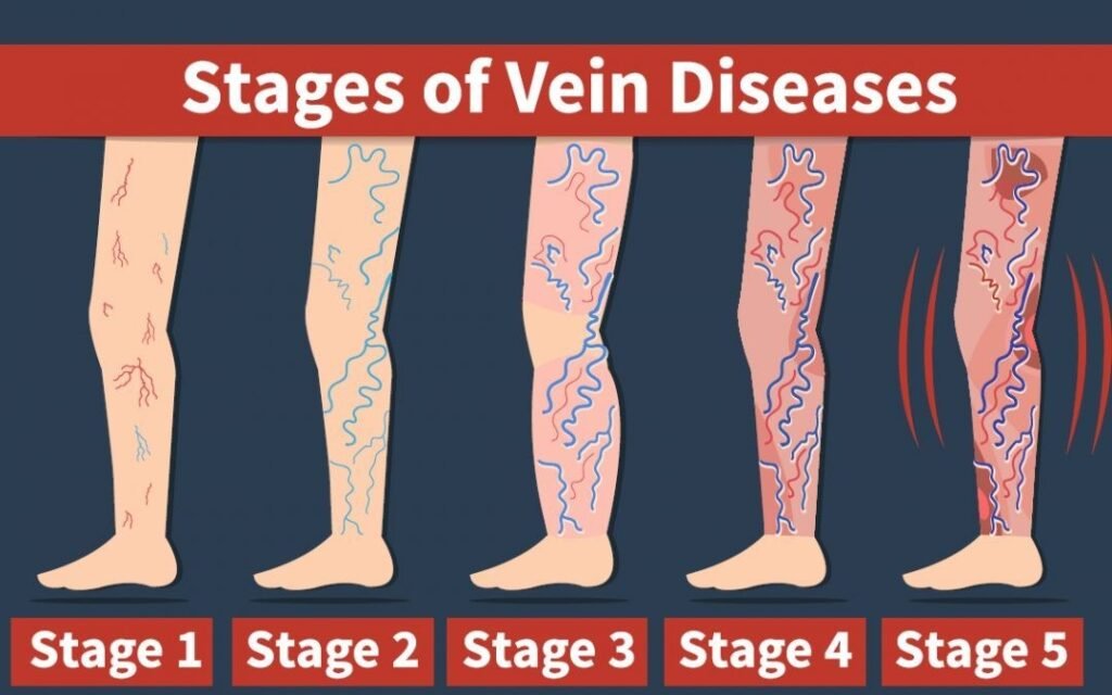 Stages of Vein Diseases