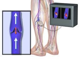 Endovenous Ablation The Ultimate Guide to the Procedure 2