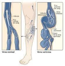 How to Prepare for the Unprecedented Effects of a Vein Ablation 2