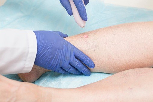 Why Varicose Vein Treatment Can be Extremely Dangerous for Children Under 5 2