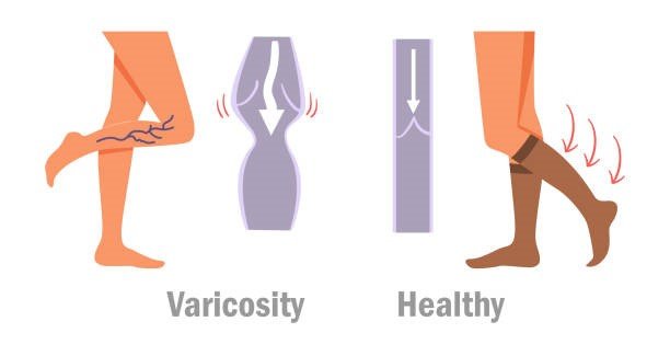 Relieve Discomfort with Samson Varicose Vein Stockings