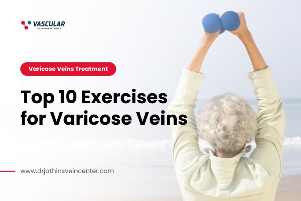 Top 10 Exercises for Varicose Veins
