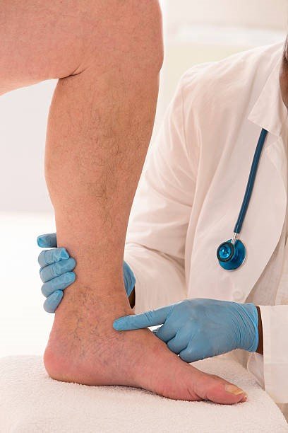 Varicose and Spider Veins