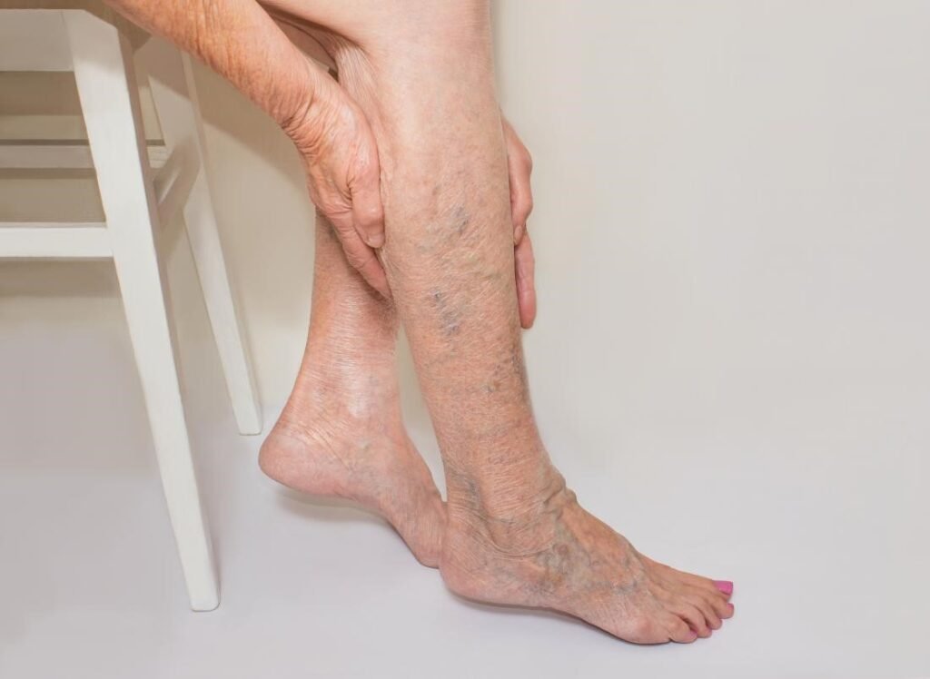 Does varicose veins make you feel ill 1