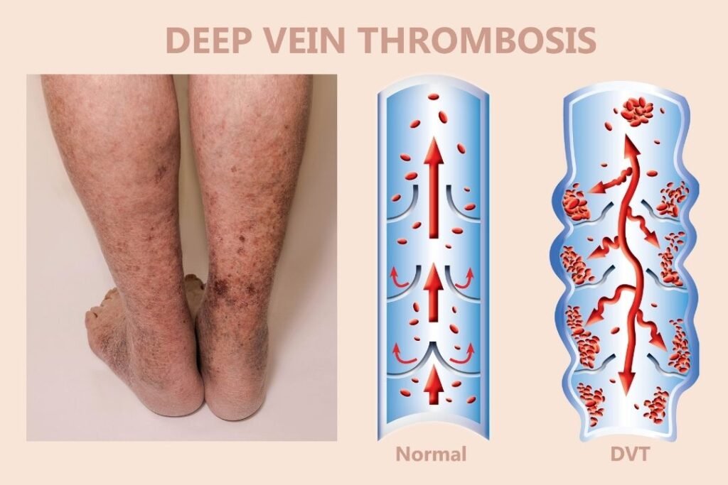 To Deep Vein Thrombosis Diagnosis