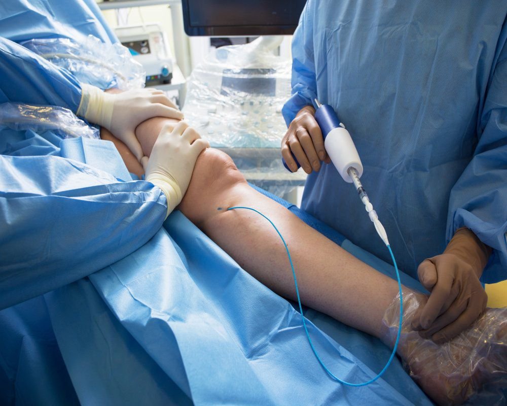 Varicose veins Catheter insertion