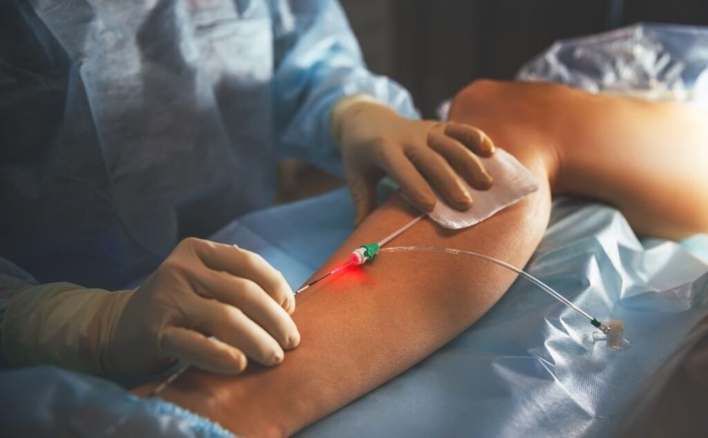 Varicose veins laser treatment