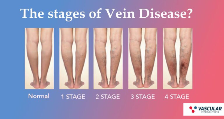 What are the stages of Vein Disease?