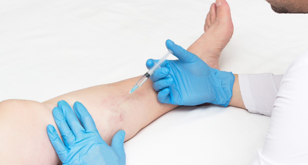 Is surgery the only option for varicose veins?