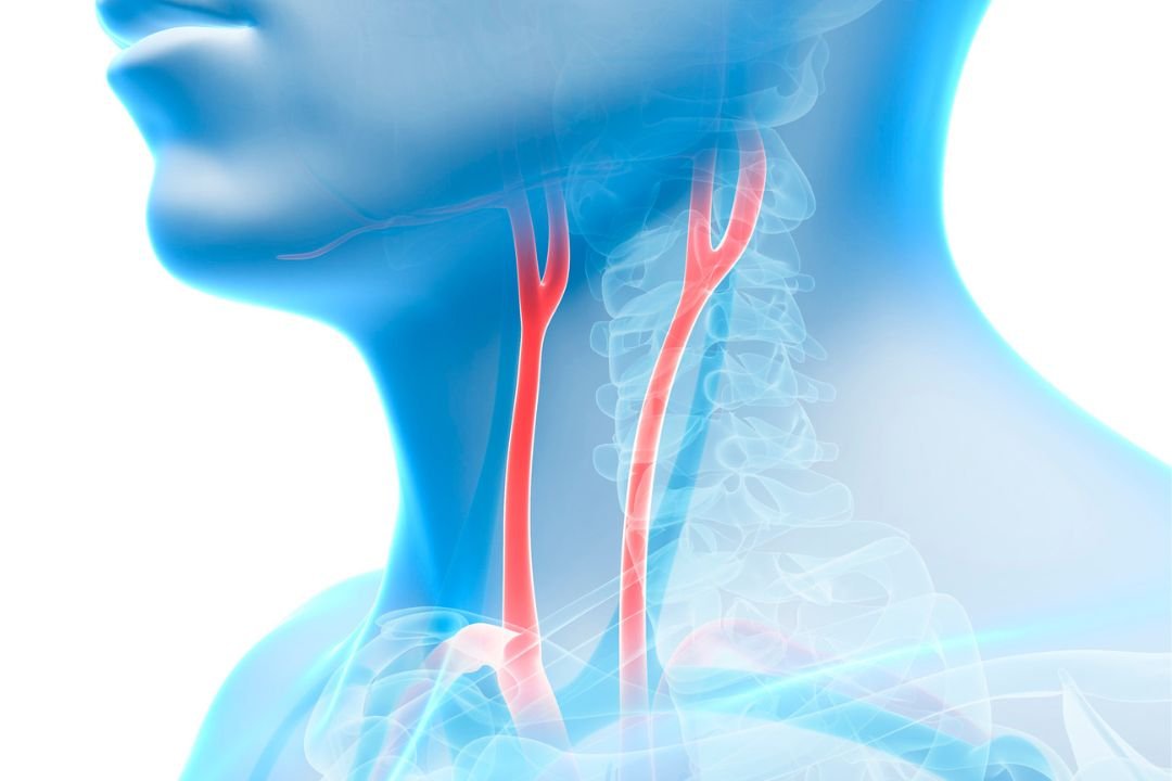 Exploring The Different Types Of Carotid Artery Blockage Treatment Dr Jathins Vein Center 2656