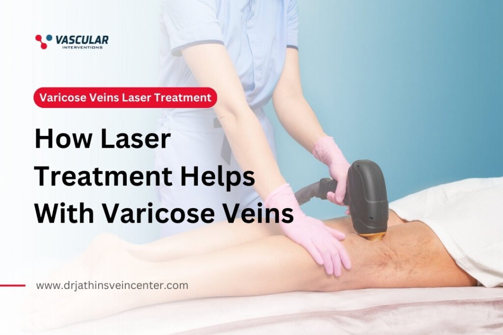 How Laser Treatment Helps With Varicose Veins