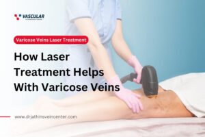 How Laser Treatment Helps With Varicose Veins