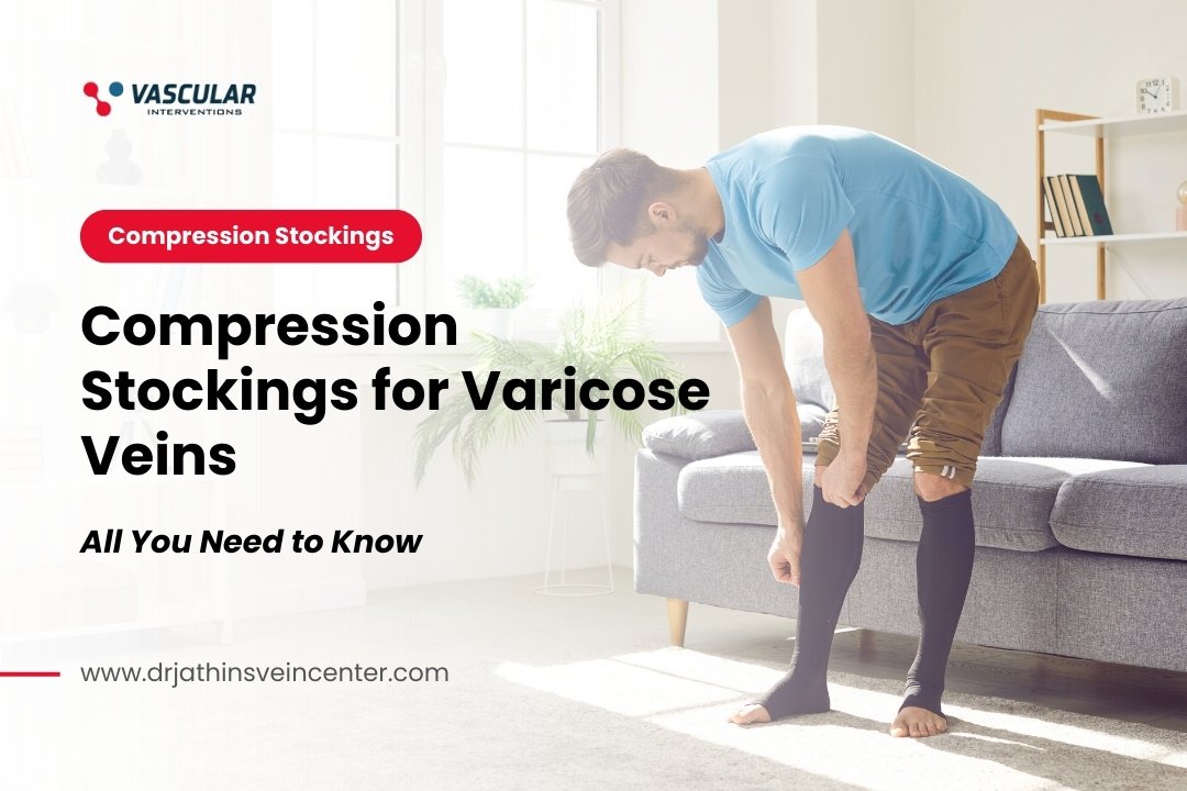 Compression Stockings for Varicose Veins: All You Need to Know