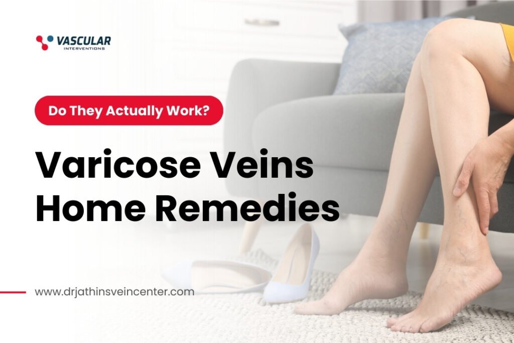 Varicose Veins Home Remedies: Do They Actually Work?