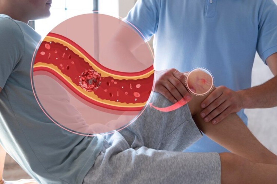 Peripheral Arterial Disease