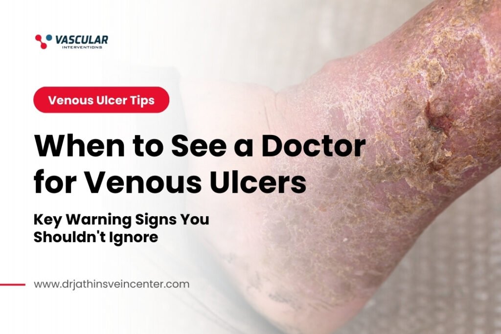 When to See a Doctor for Venous Ulcers Key Warning Signs You Shouldnt Ignore