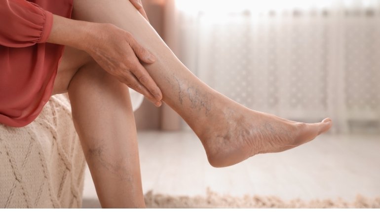 Deep Vein Thrombosis DVT Treatment