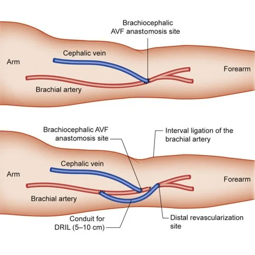 Revascularization Of Dialysis AVFs Dr.Jathins Vein Center