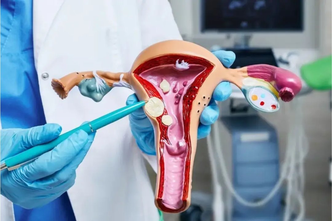 Uterine Fibroid Embolization