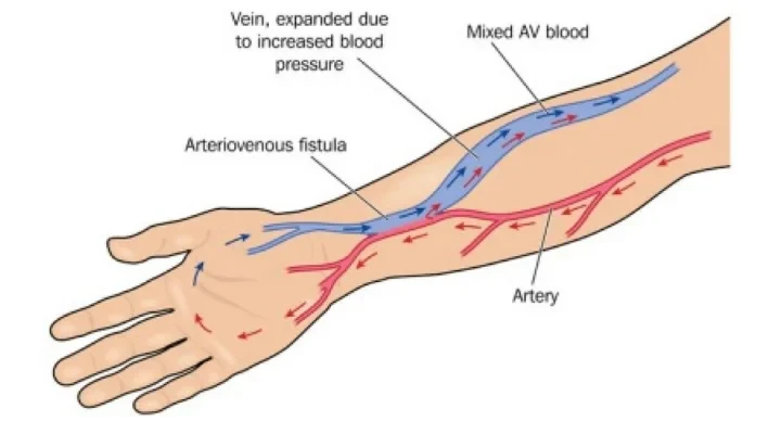 Arteriovenous Fistula access for Dialysis 1