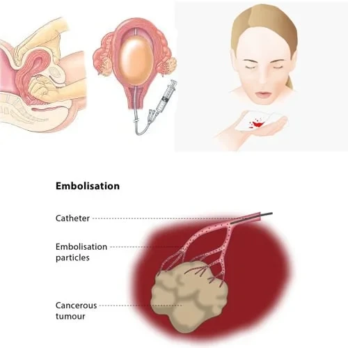 Bleeding States PPH Haemoptysis Tumour Embolization - Dr Jathin Vein Center