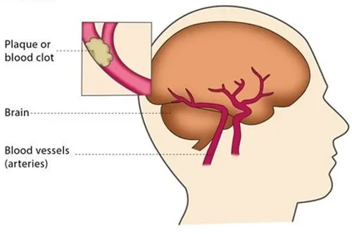 Endovascular Treatment Of Neurovascular Disorders Dr. Jathin