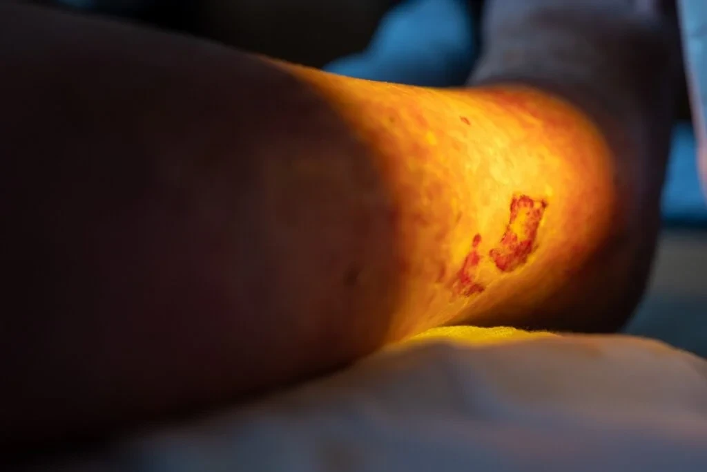 Leg ulcer treatment in Mumbai