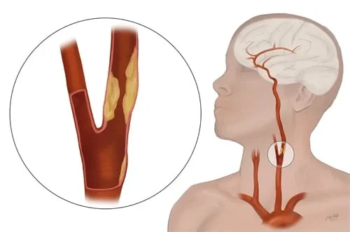Stroke Carotid Artery Disease Dr.Jathins Vein Center