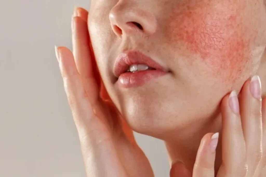 Face Spider Veins Treatment in Mumbai