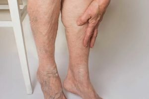 Peripheral-Vascular-Disease-Dr.Jathin's-Vein-Center